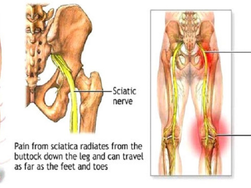 Cervical Pain  Rekief Chiropractor Bundall Near Me